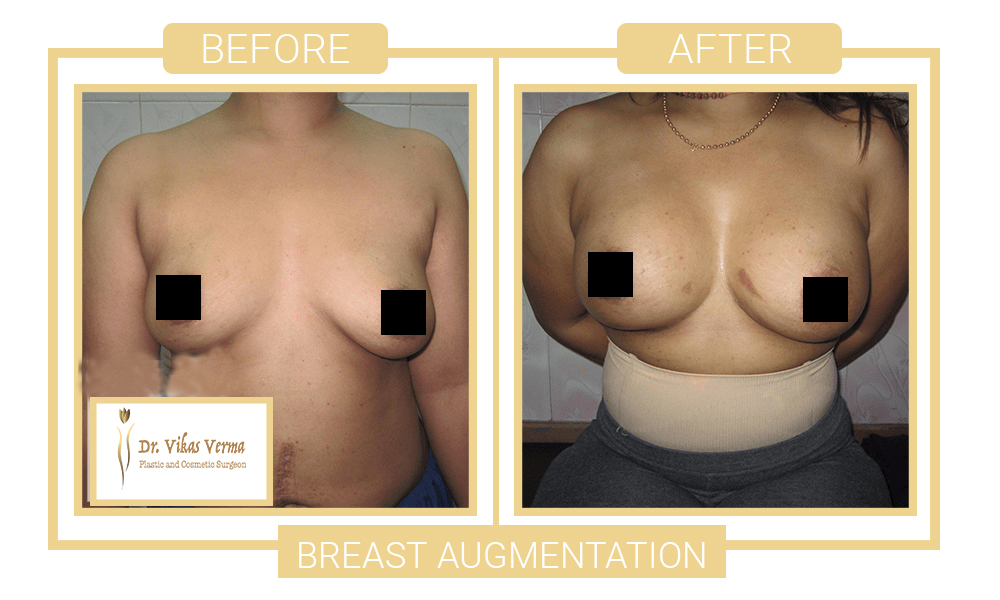 breast augmentation patient 2