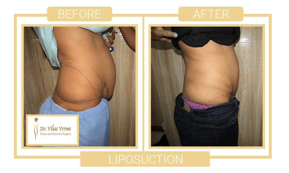 liposuction patient 2 w