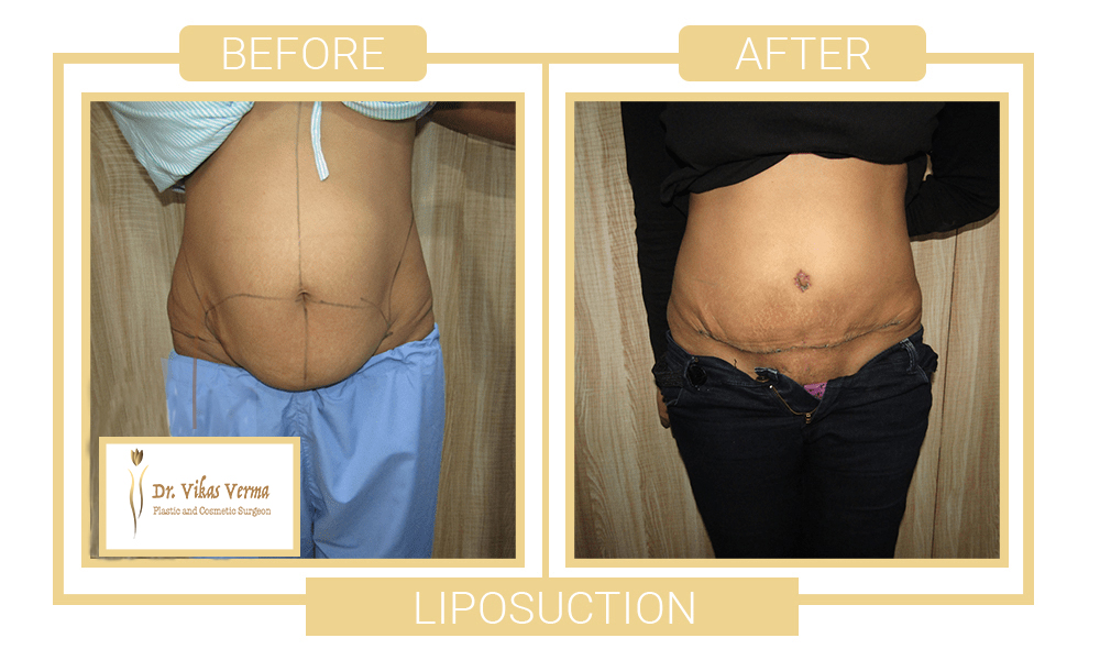 liposuction patient 3 w