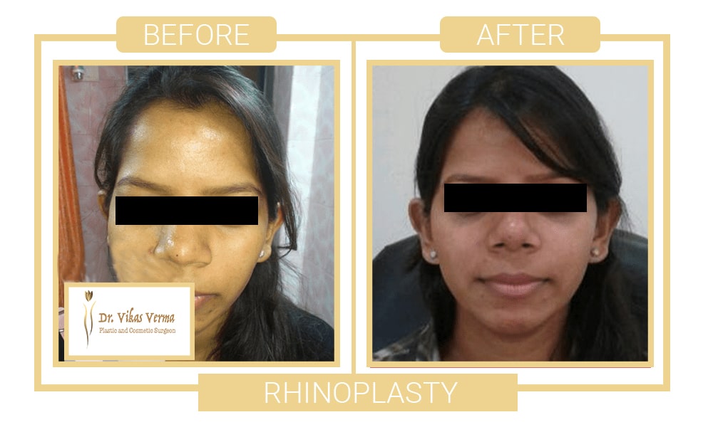rhinoplasty patient Before & After