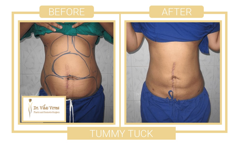Before and After Pictures - Tummy Tuck Surgery in Dubai