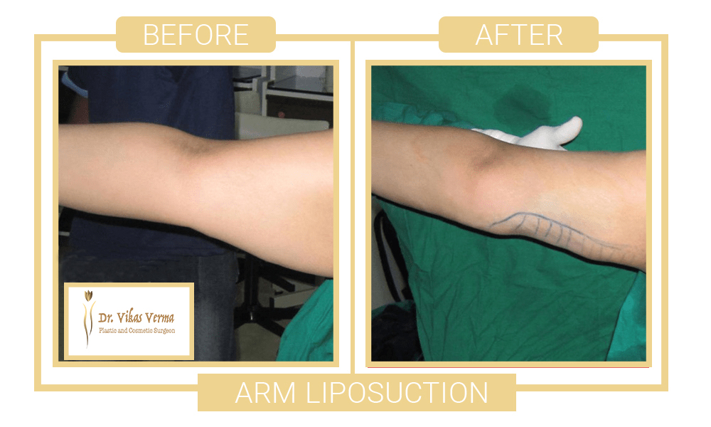 ARM LIPOSUCTION PATIENT 2