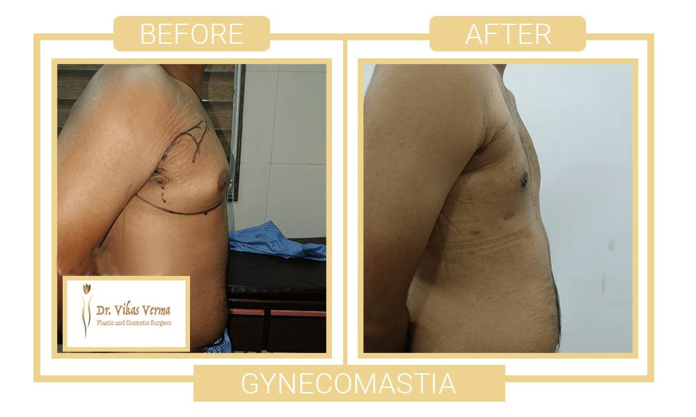 gynecomastia patient 4 (1)