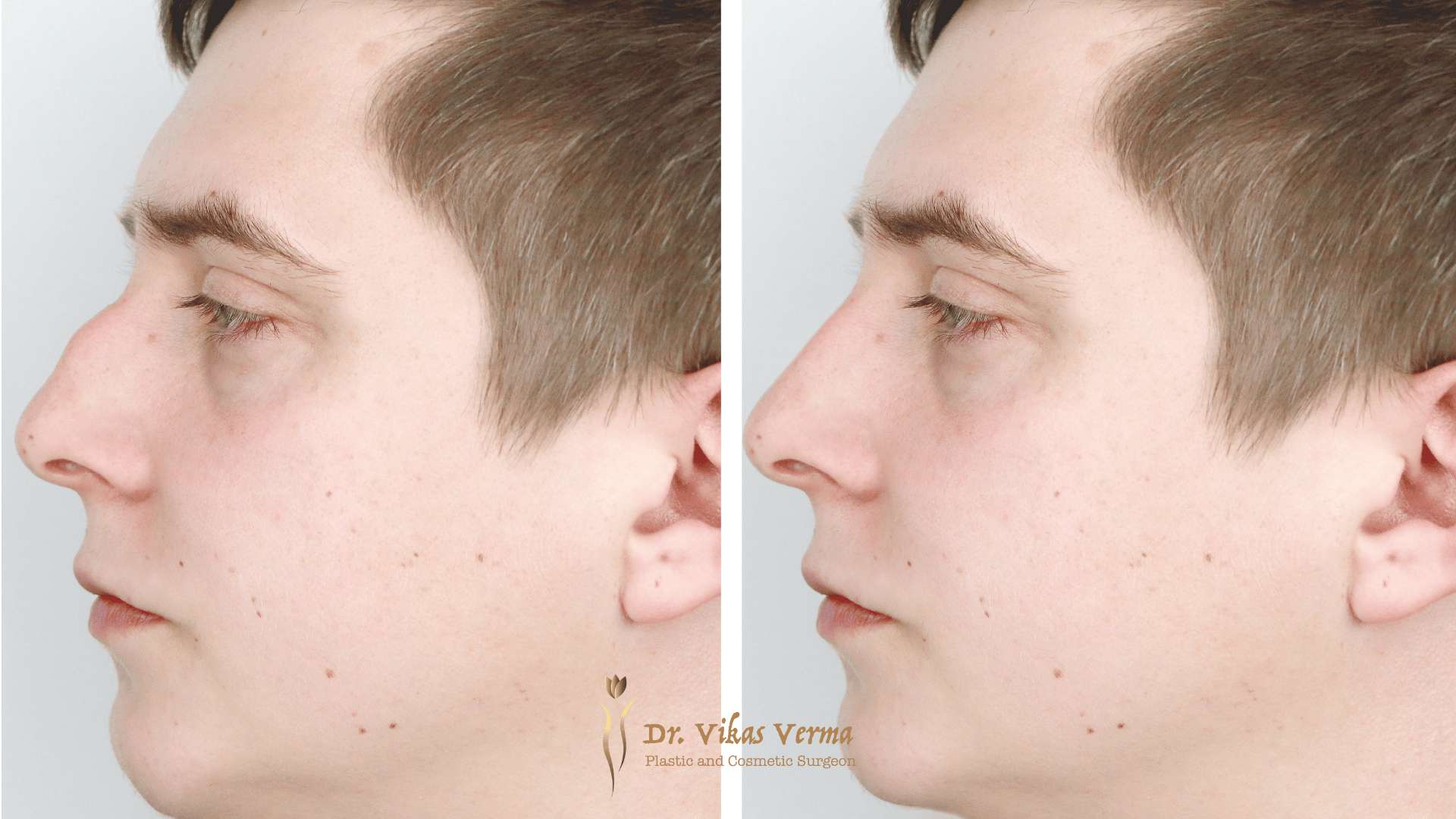 Top 5 Benefits of Rhinoplasty In Dubai