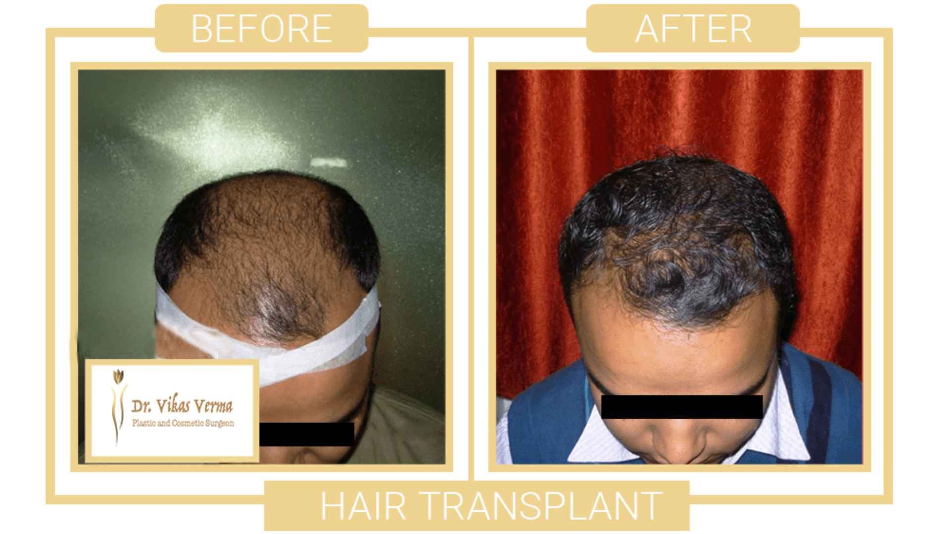 Hair Transplant