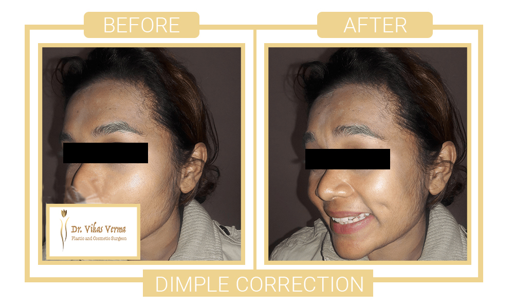 DIMPLE CORRECTION PATIENT 2