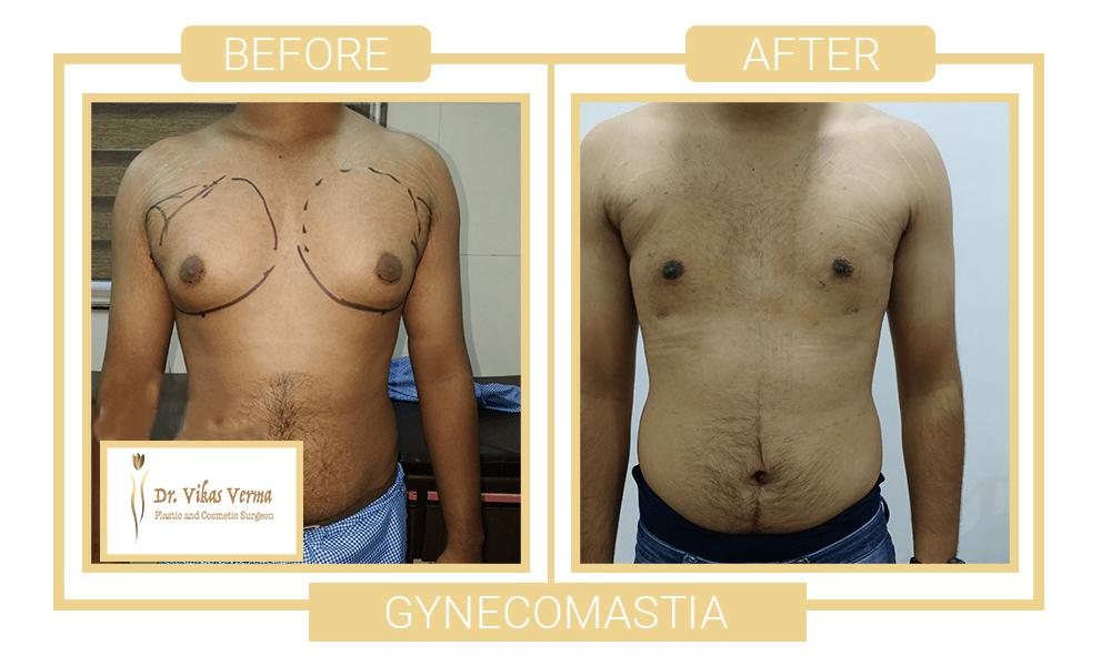 gynecomastia patient 2 1