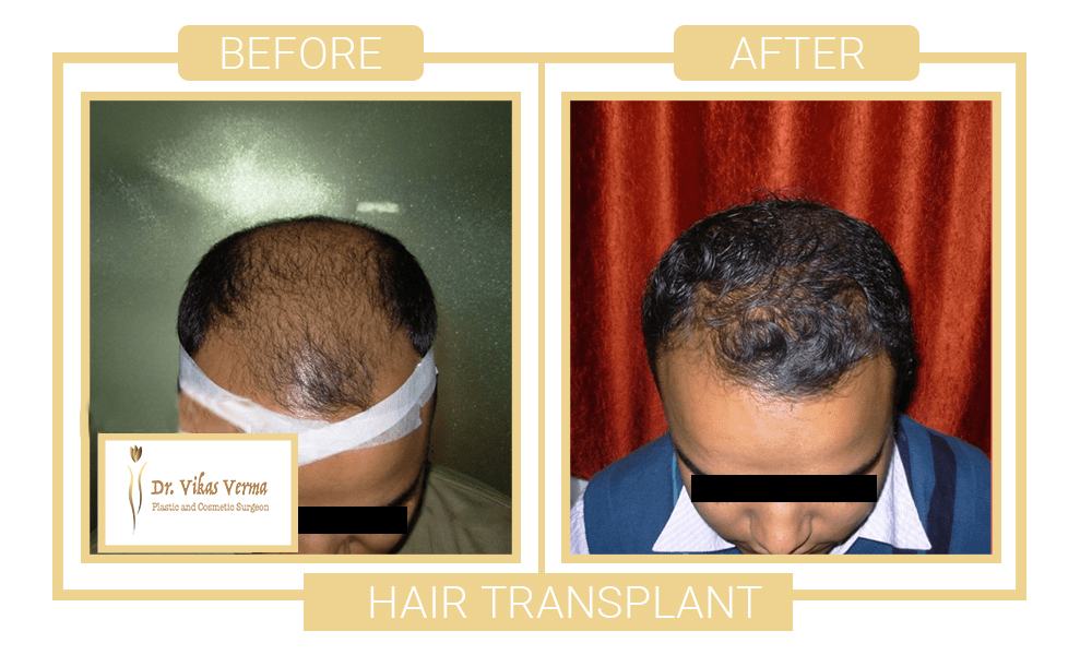 hair plant patient 1 3